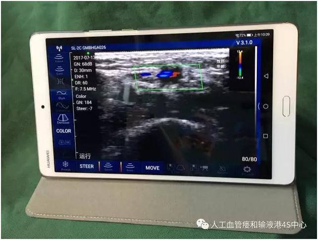 无线制导技术延续透析生命线无限生机 ——中国首例无线便携式B超引导下透析通路腔内成型术在北京大学第一医院血管外科顺利完成